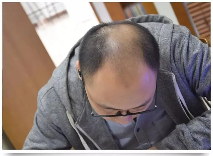 羡慕了！韩政府将向年轻脱发患者提供补贴
